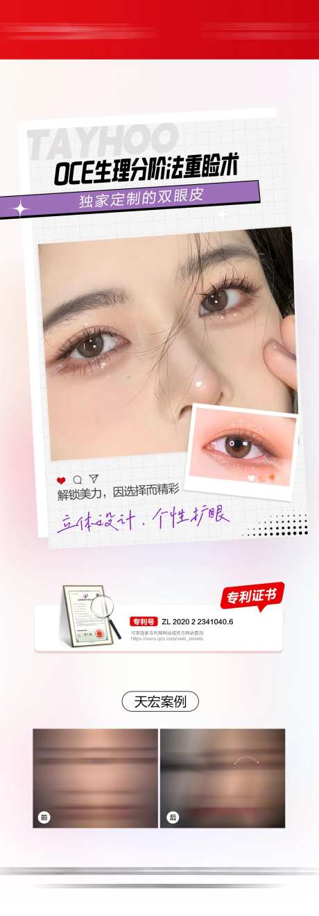 双眼皮重睑术系列图-采灵感-https://www.cailinggan.com/