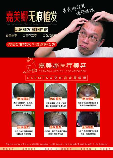 医美植发案例-采灵感-https://www.cailinggan.com/