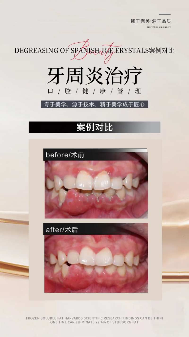 牙周炎治疗对比图海报-采灵感-cailinggan.com