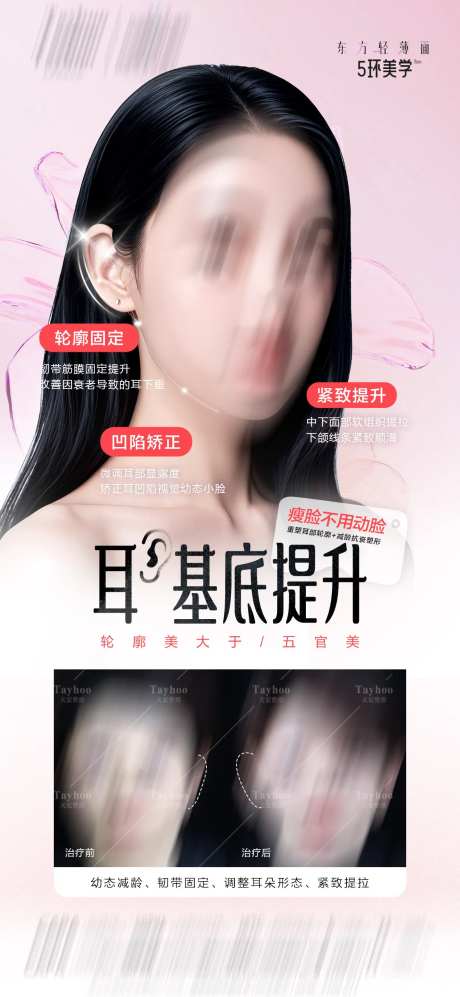 耳基底提升-采灵感-https://www.cailinggan.com/