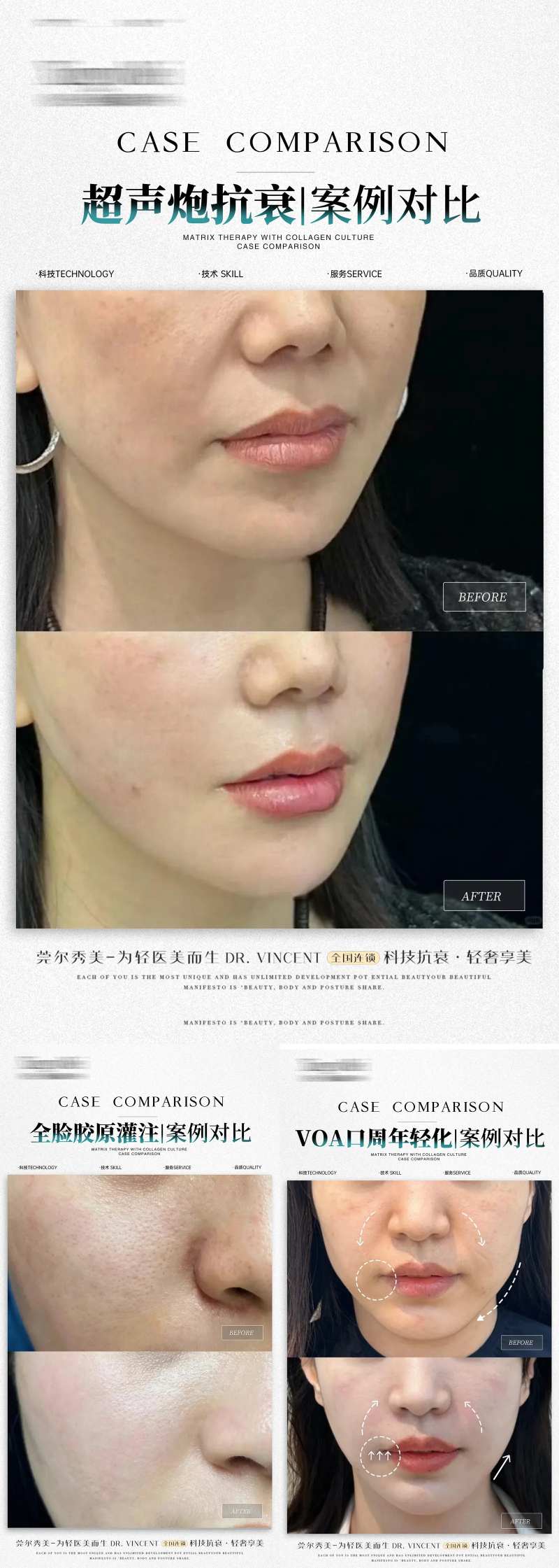医美超声炮胶原口周案例分享系列海报-采灵感-cailinggan.com