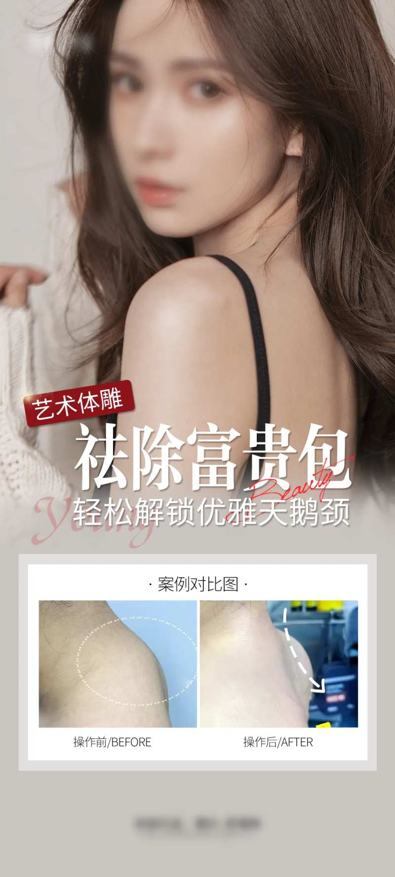祛除富贵包案例海报-采灵感-cailinggan.com