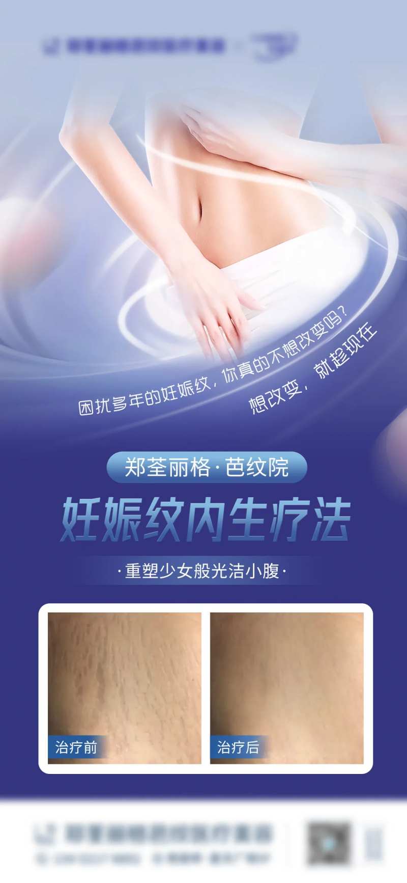 妊娠纹医美移动端海报-采灵感-cailinggan.com