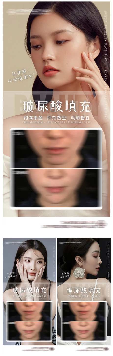 医美玻尿酸案例对比-采灵感-https://www.cailinggan.com/
