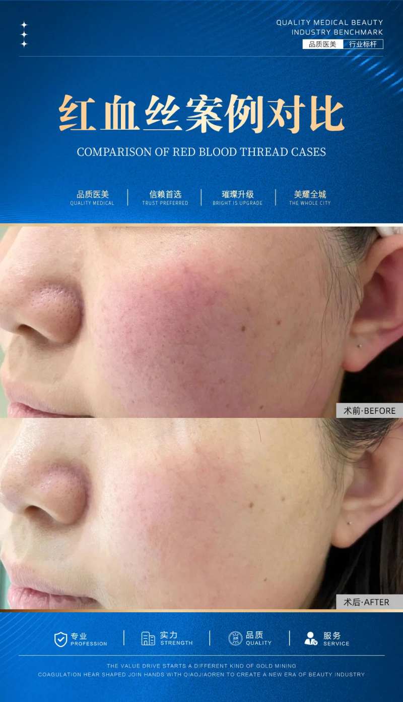 红血丝案例对比-采灵感-cailinggan.com