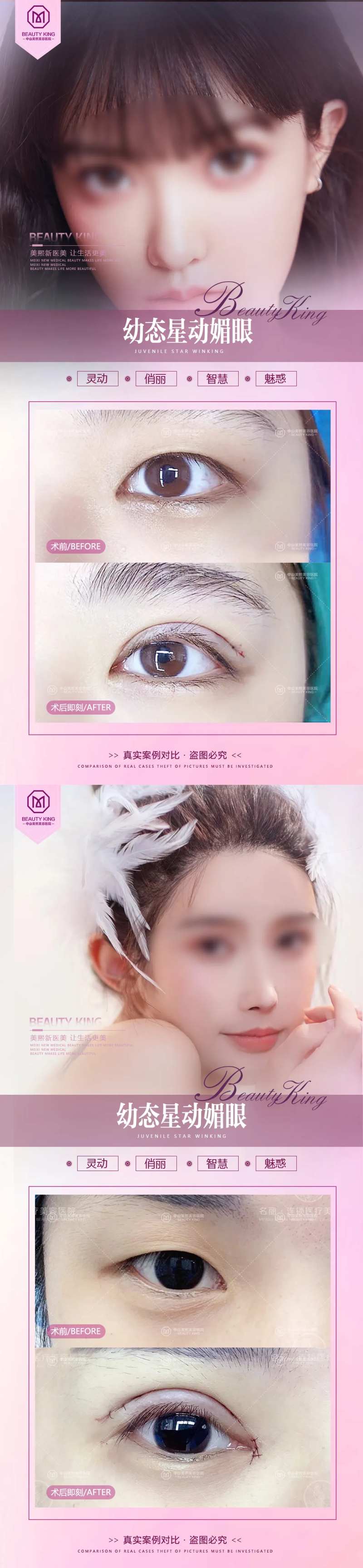 医美双眼皮案例宣传海报-采灵感-cailinggan.com