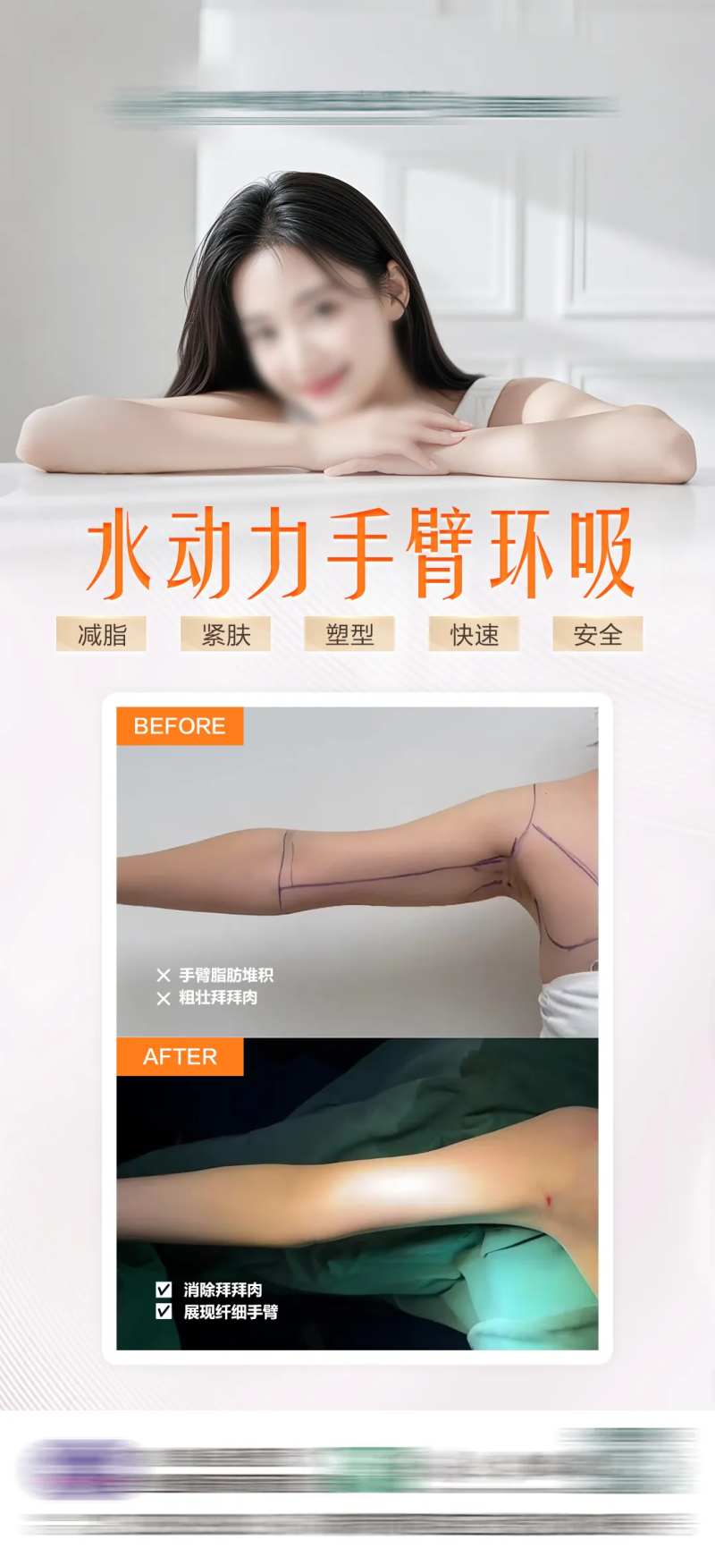 水动力手臂吸脂-采灵感-cailinggan.com