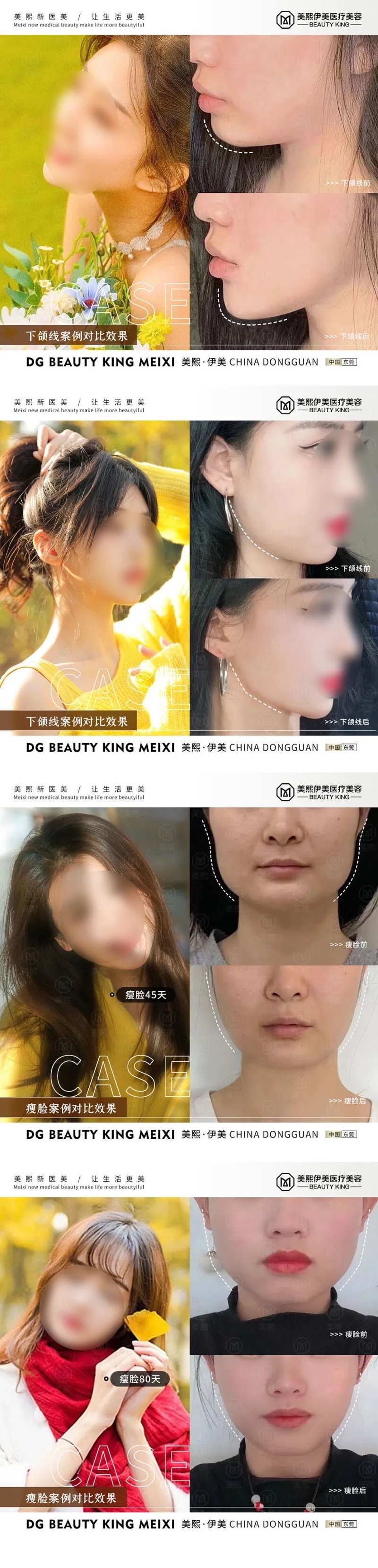 瘦脸案例系列海报-采灵感-cailinggan.com