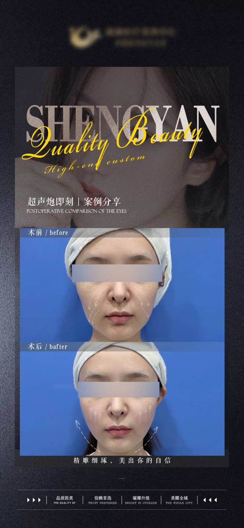 超声炮术前术后对比案例海报可更换-采灵感-cailinggan.com