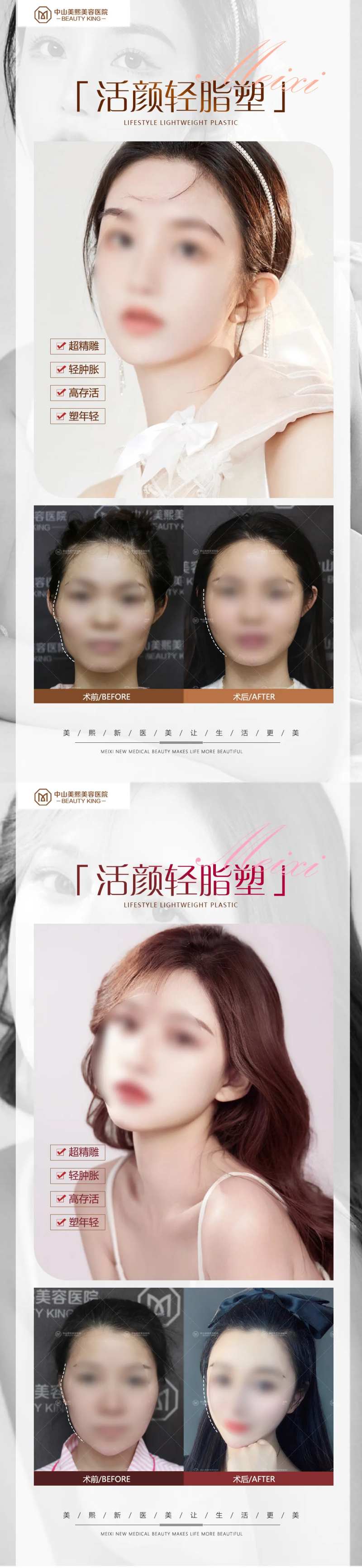 医美脸部填充案例海报-采灵感-cailinggan.com