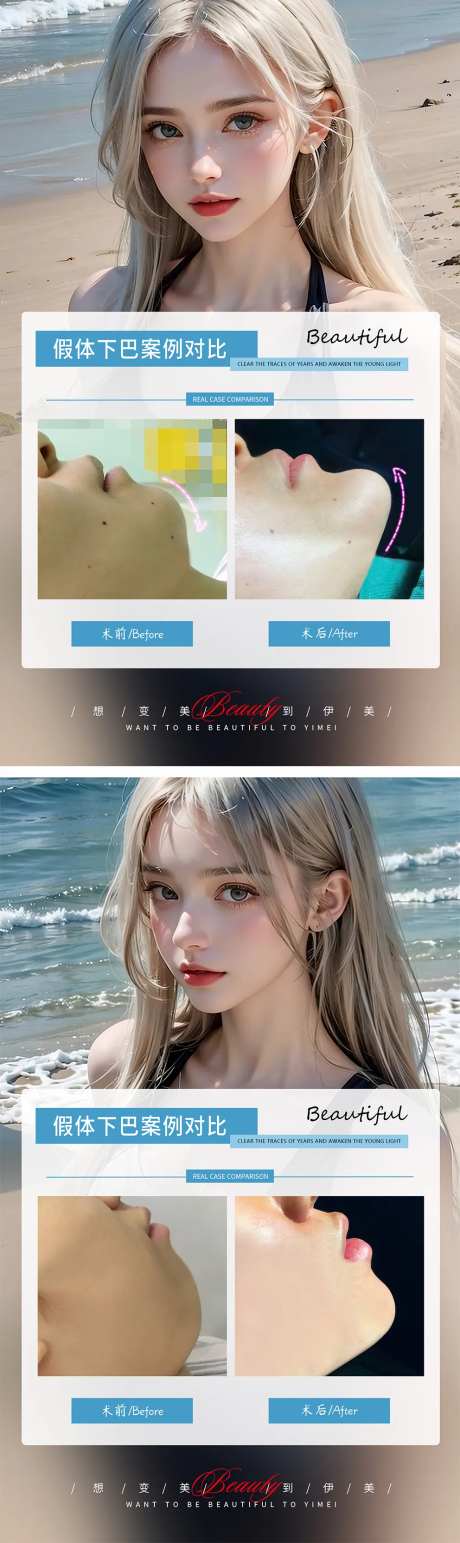 假体丰下巴案例对比-采灵感-https://www.cailinggan.com/