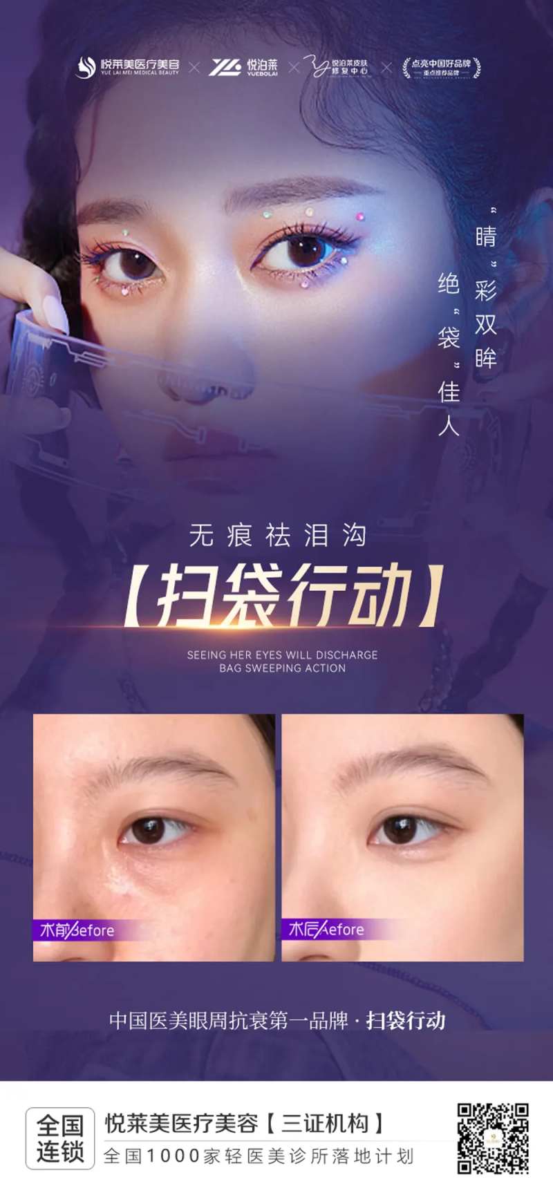 祛眼袋案例-采灵感-cailinggan.com