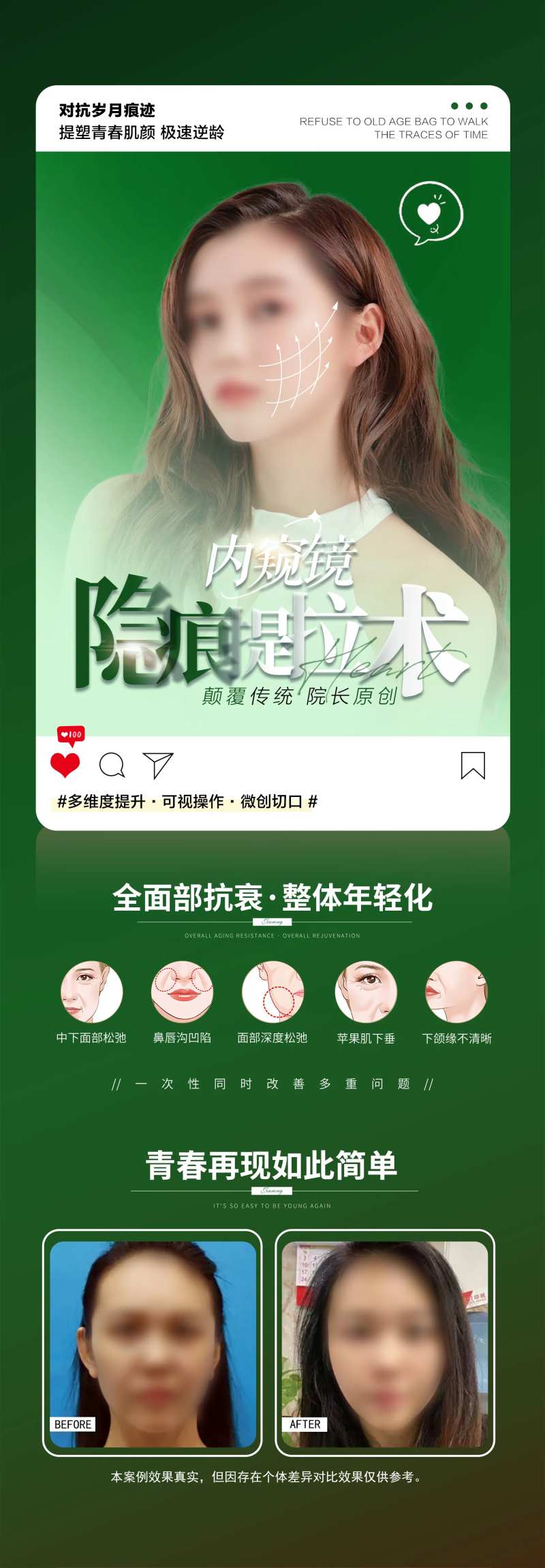 内窥镜隐痕提拉术-采灵感-cailinggan.com
