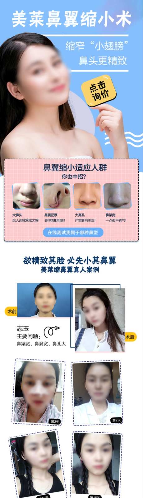 医美鼻翼缩小术详情页-采灵感-https://www.cailinggan.com/