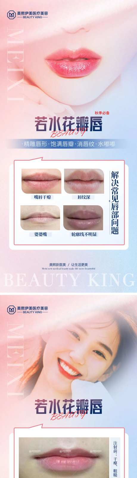 玻尿酸丰唇-采灵感-https://www.cailinggan.com/