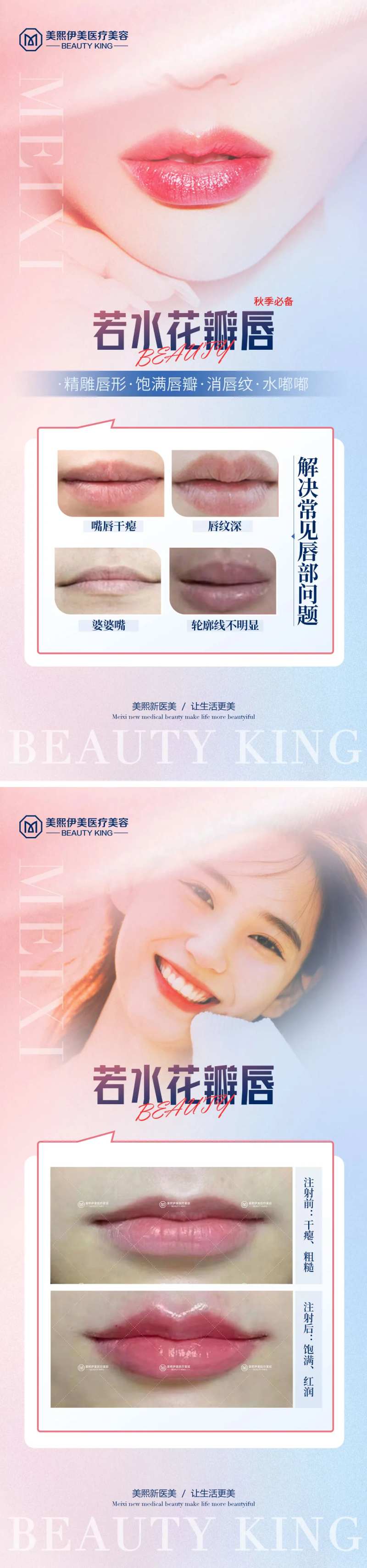 玻尿酸丰唇-采灵感-cailinggan.com