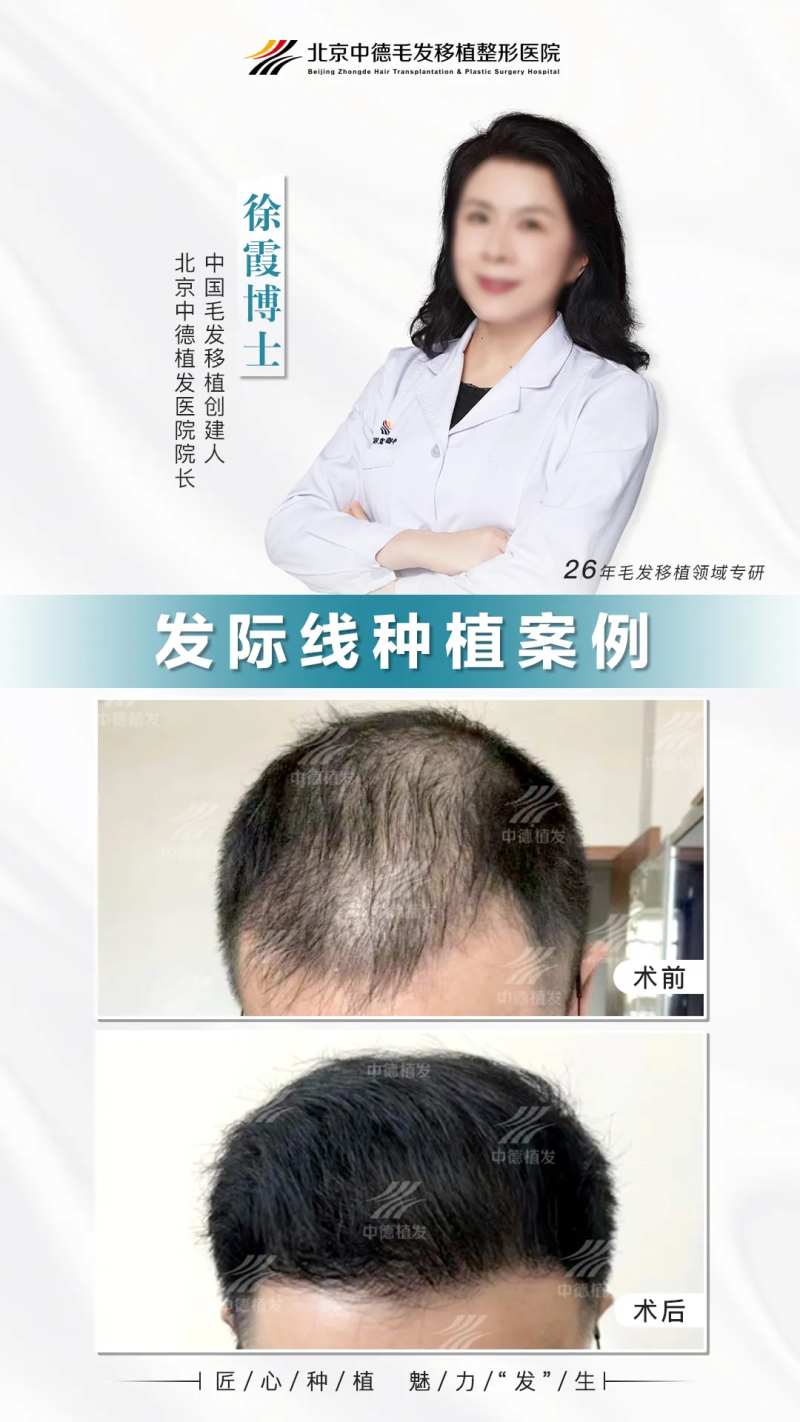 植发真实案例-采灵感-cailinggan.com