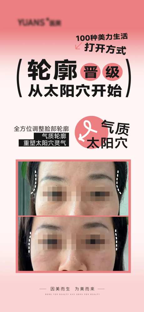 医美太阳穴填充案例对比海报-采灵感-https://www.cailinggan.com/