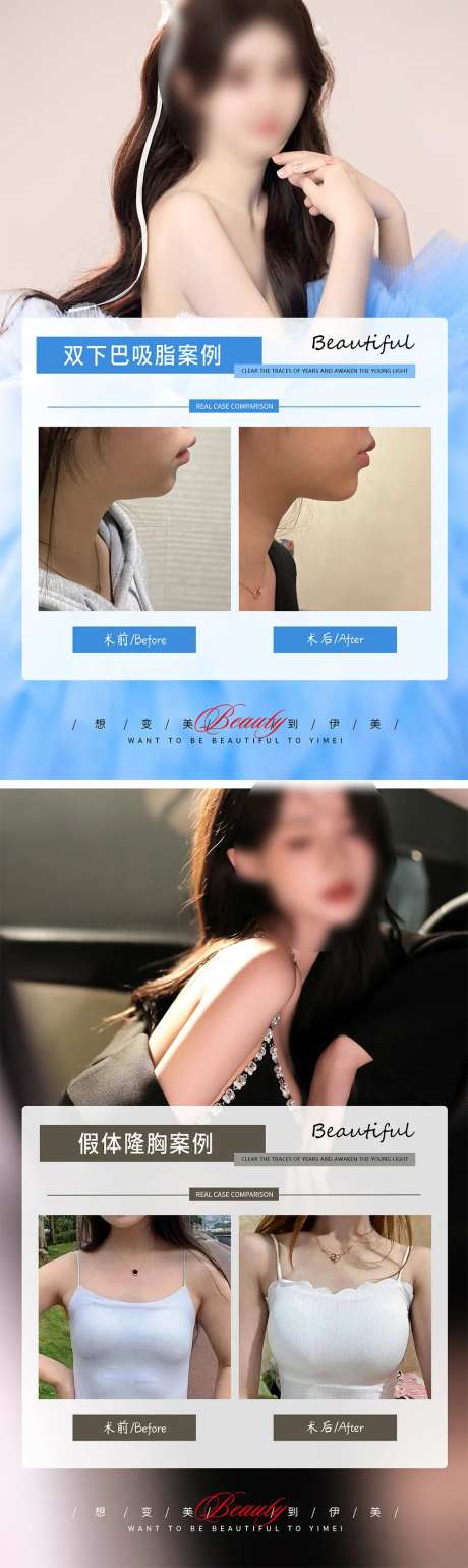 下巴吸脂假体隆胸案例-采灵感-https://www.cailinggan.com/