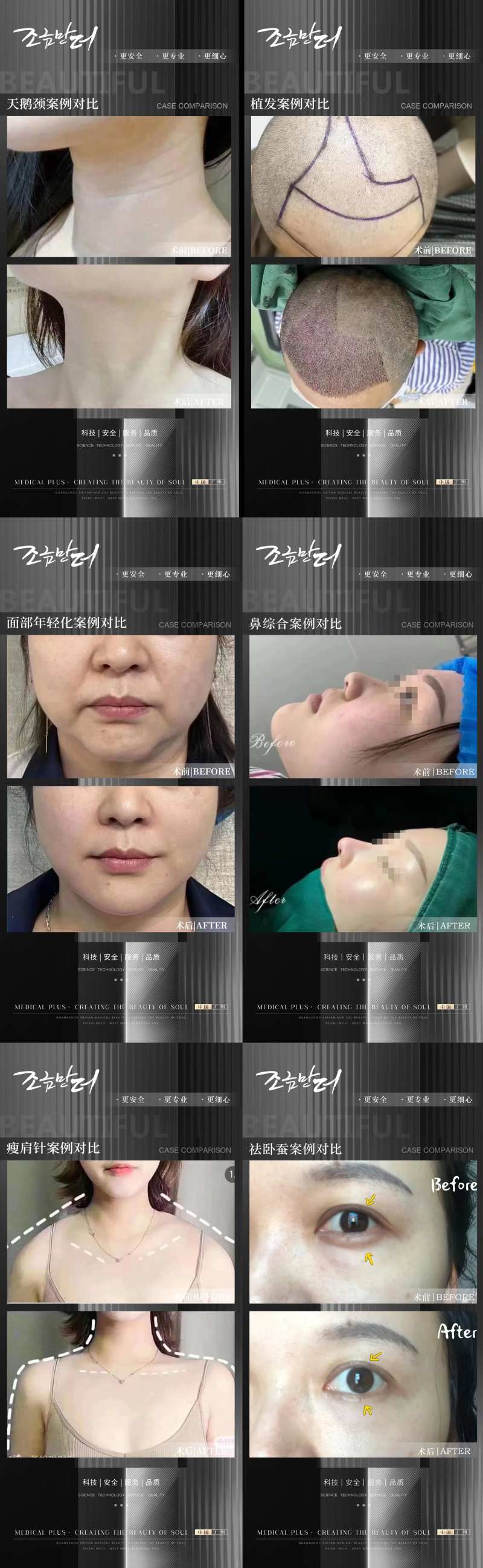医美植发案例海报 -采灵感-cailinggan.com