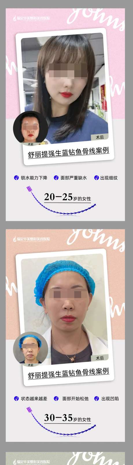 舒立提强生蓝钻鱼骨线-采灵感-https://www.cailinggan.com/