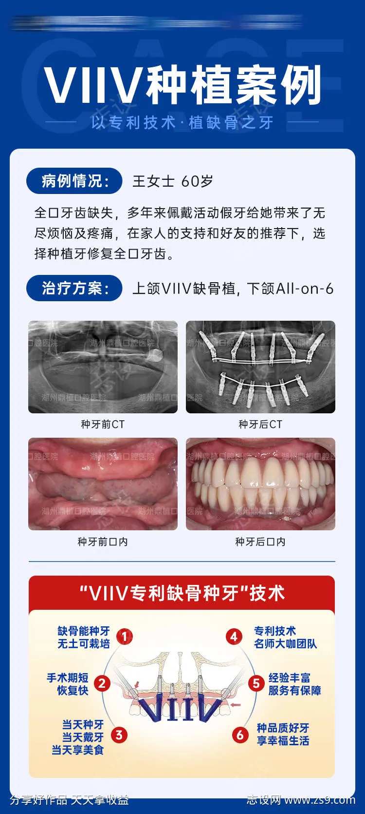 全口种植牙案例对比图海报-采灵感-cailinggan.com