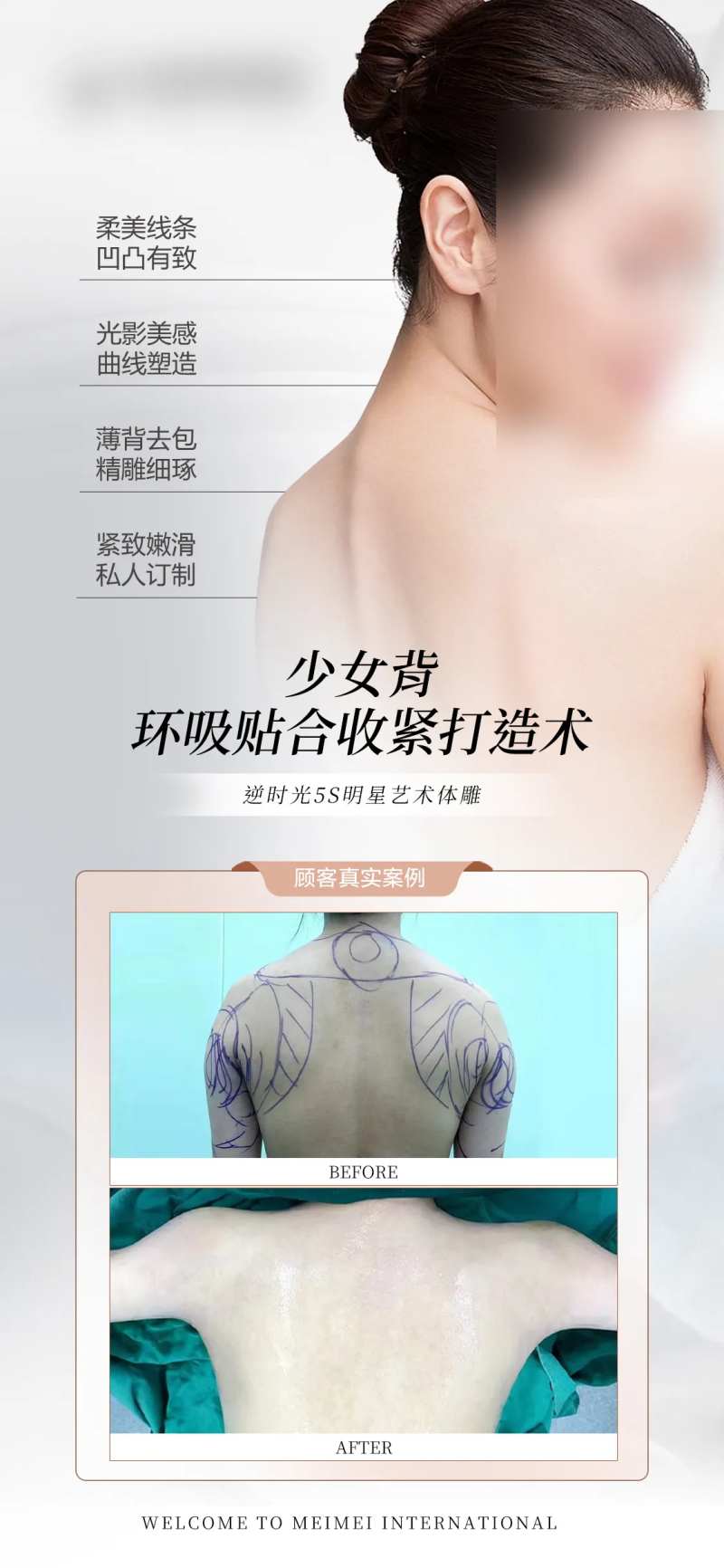 医美少女背整形案例-采灵感-cailinggan.com