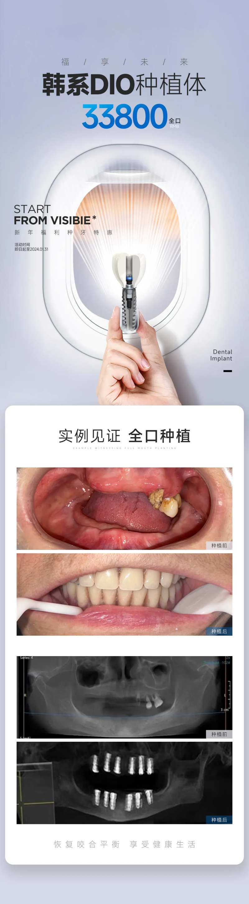 种植牙案例对比图-采灵感-cailinggan.com