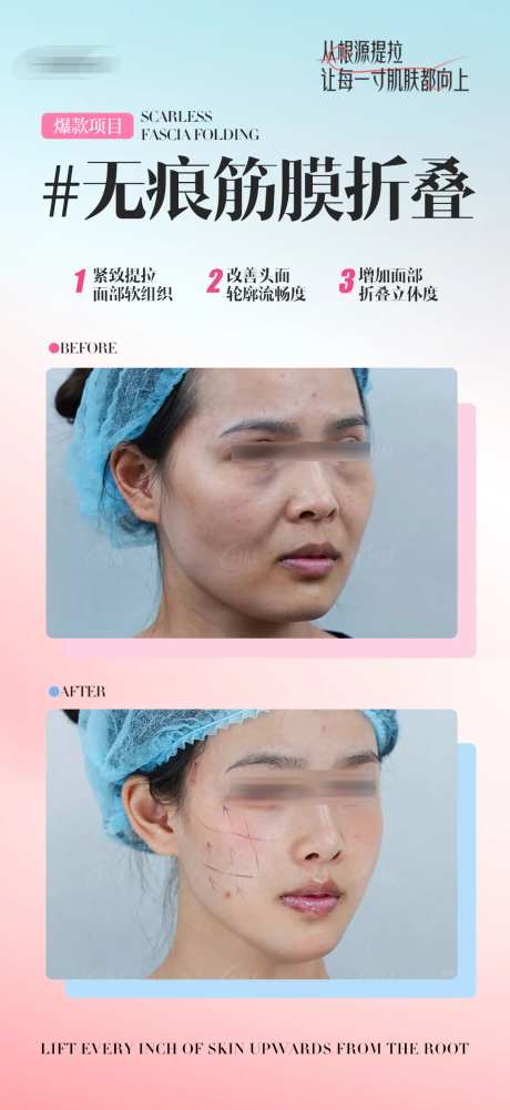 无痕筋膜折叠-采灵感-https://www.cailinggan.com/