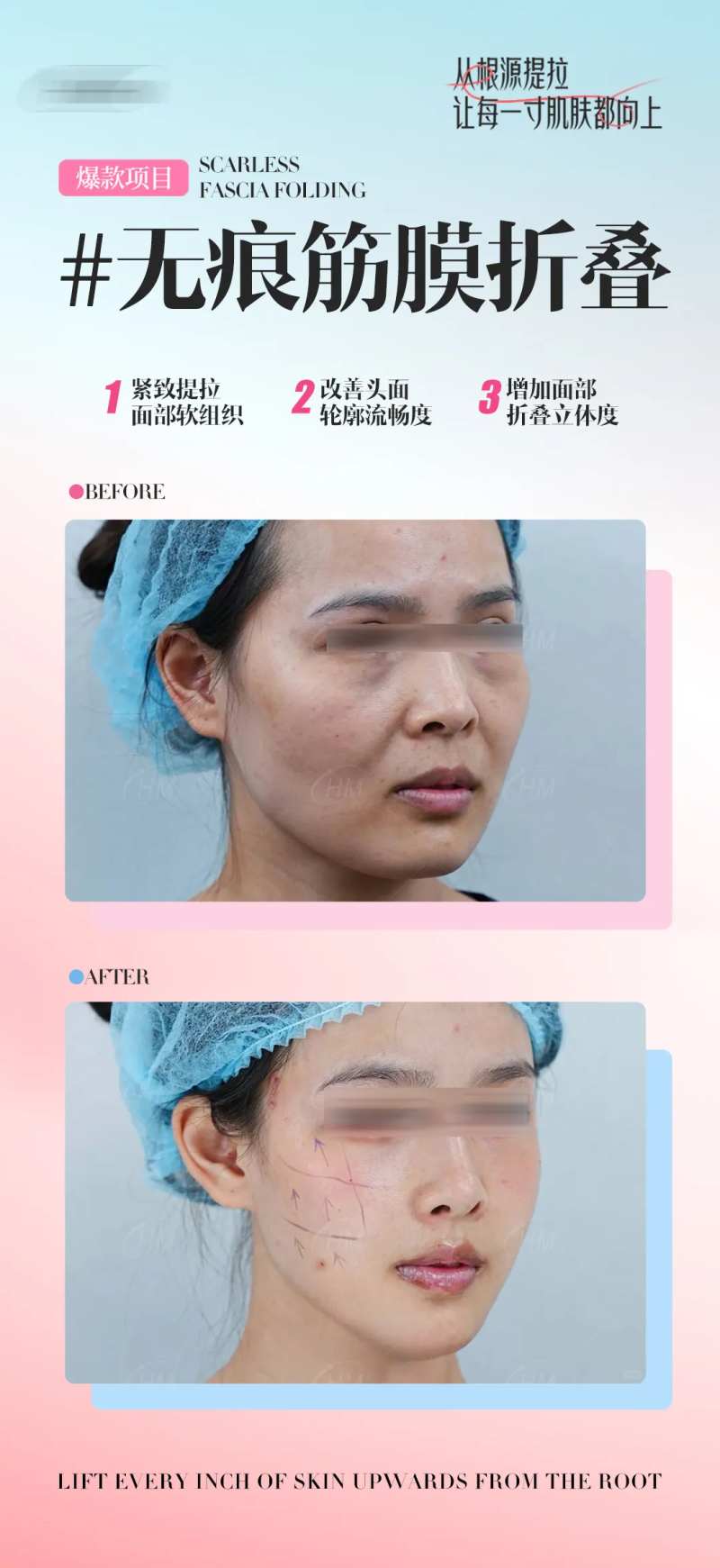 无痕筋膜折叠-采灵感-cailinggan.com