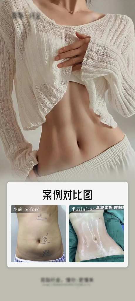 医美腰腹吸脂宣传海报-采灵感-https://www.cailinggan.com/