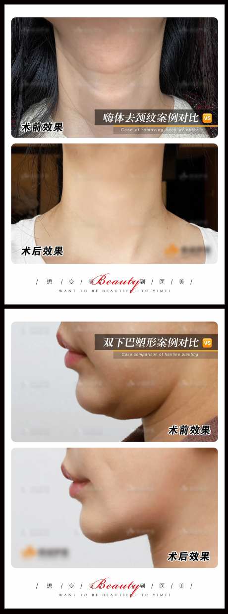 医美案例模板系列海报-采灵感-https://www.cailinggan.com/