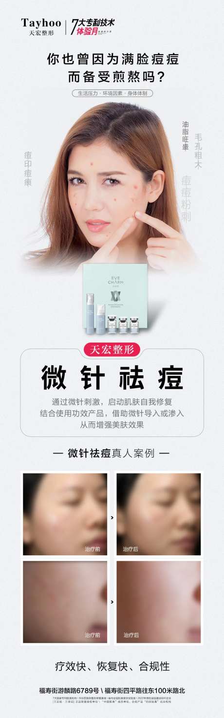 微针祛痘长图-采灵感-https://www.cailinggan.com/