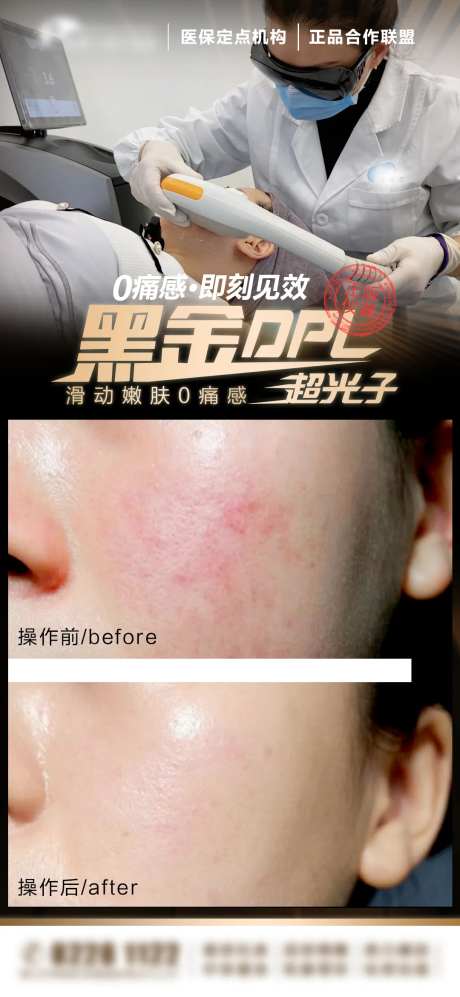 aopt m22黄金超光子嫩肤案例-采灵感-https://www.cailinggan.com/