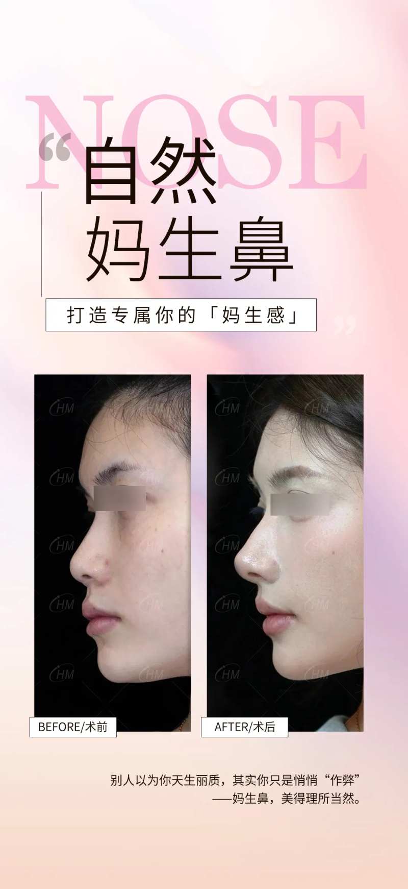 自然妈生鼻案例海报-采灵感-cailinggan.com