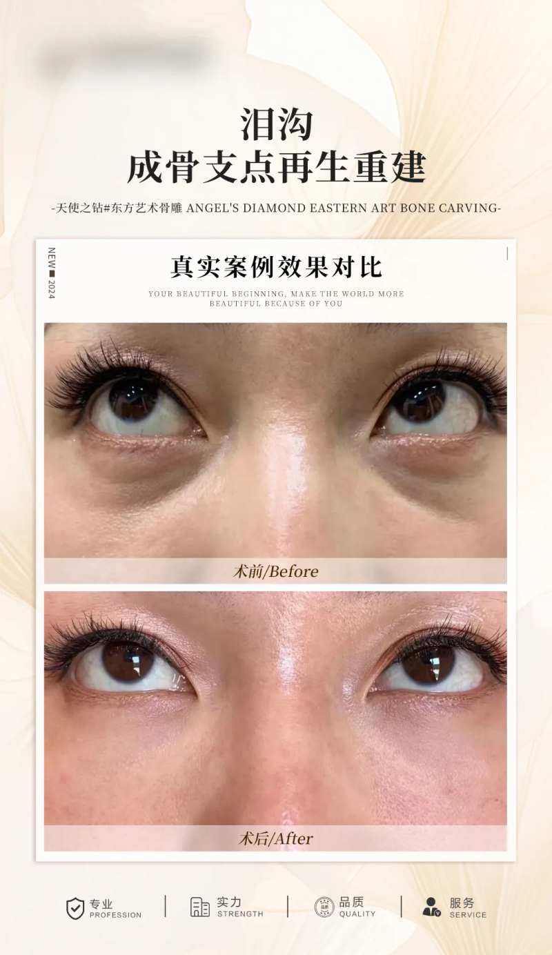 泪沟案例对比海报-采灵感-cailinggan.com