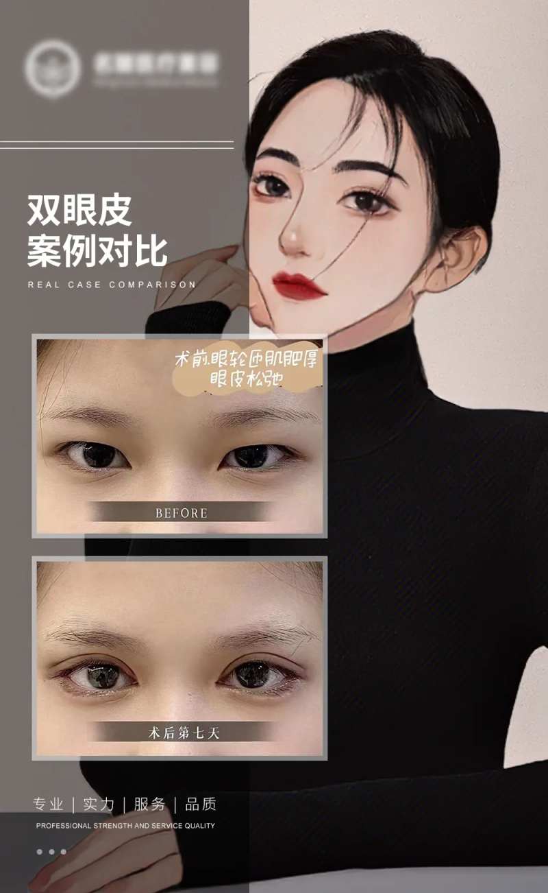 双眼皮案例对比-采灵感-cailinggan.com