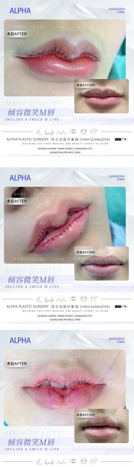 医美M唇案例-采灵感-https://www.cailinggan.com/