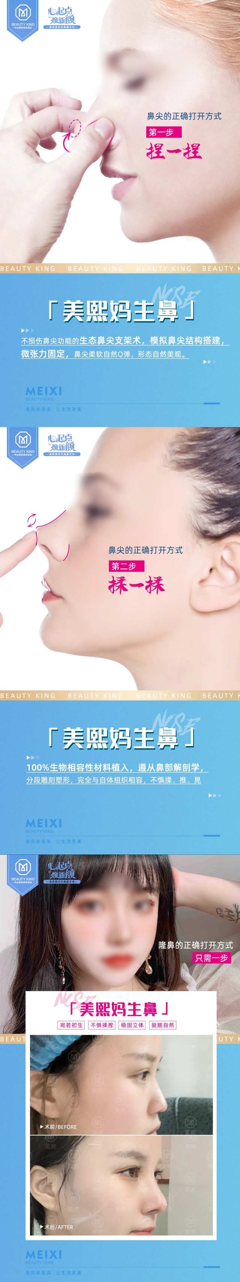 隆鼻鼻尖案例海报-采灵感-cailinggan.com