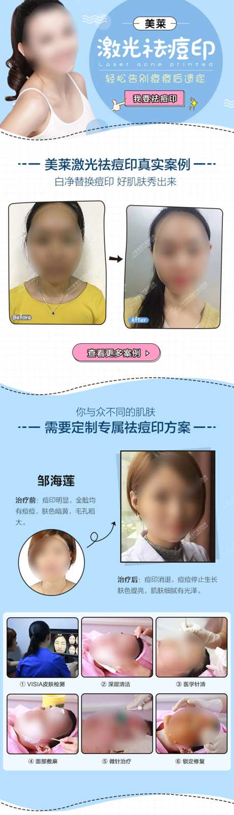 医美激光祛痘印影响详情页-采灵感-https://www.cailinggan.com/