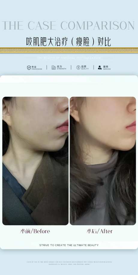 咬肌肥大治疗海报-采灵感-https://www.cailinggan.com/