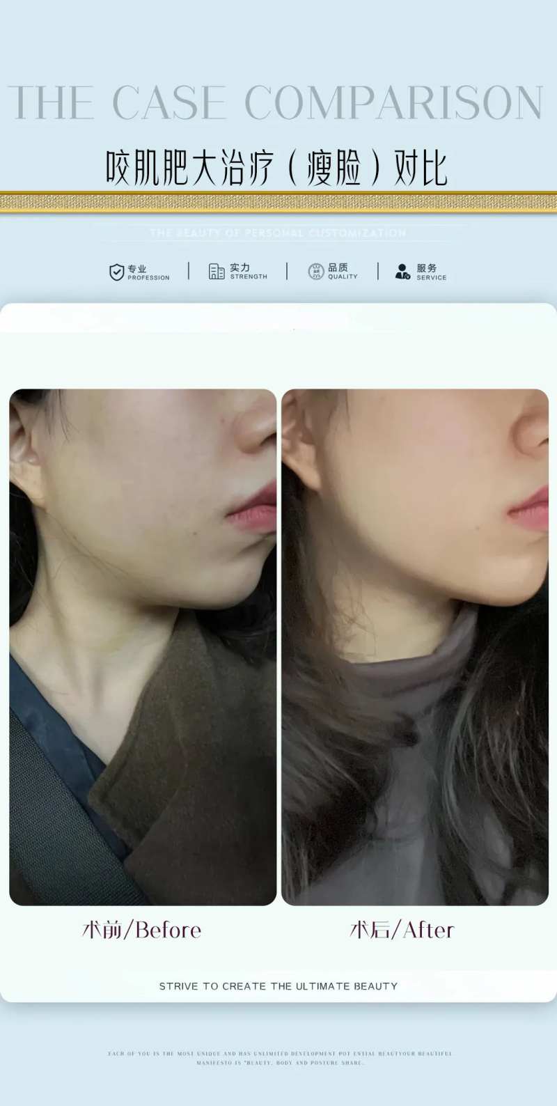 咬肌肥大治疗海报-采灵感-cailinggan.com