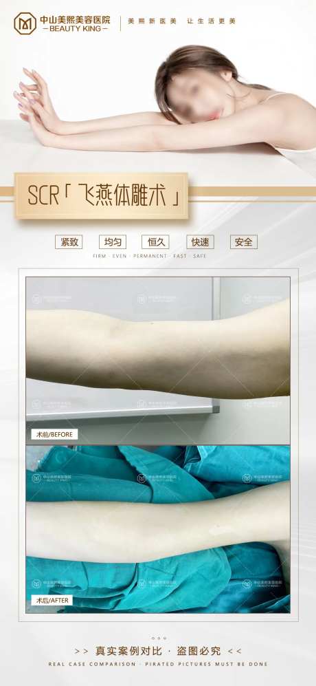 手臂吸脂案例-采灵感-https://www.cailinggan.com/