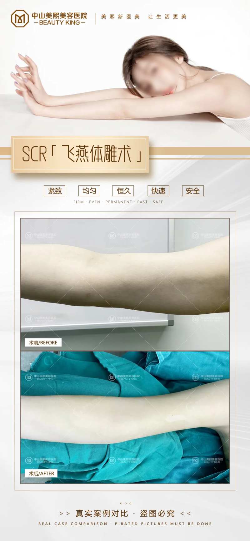 手臂吸脂案例-采灵感-cailinggan.com