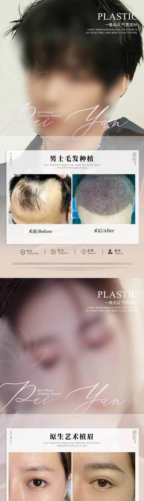 植发案例-采灵感-https://www.cailinggan.com/