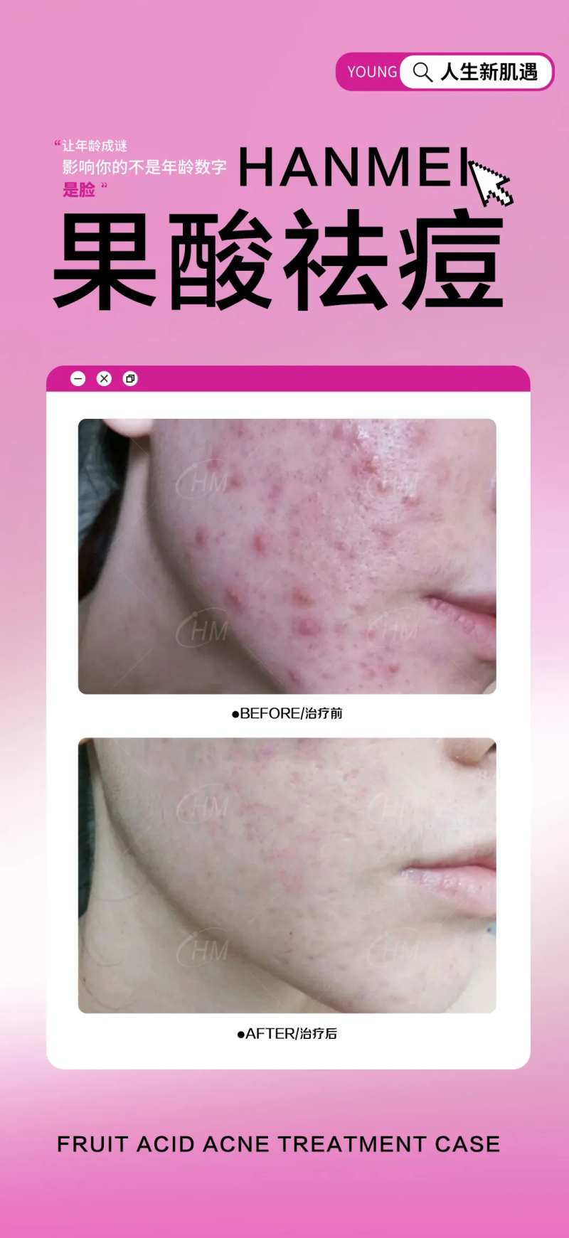 果酸祛痘-采灵感-cailinggan.com