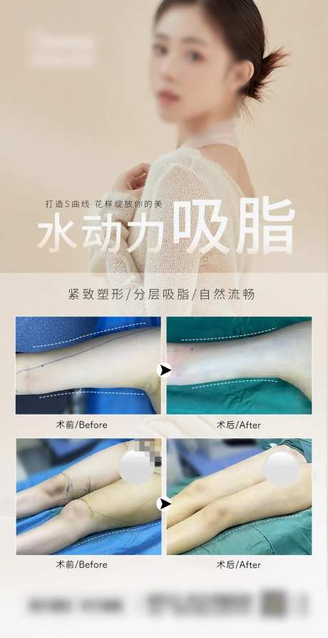 大腿胳膊吸脂案例-采灵感-https://www.cailinggan.com/