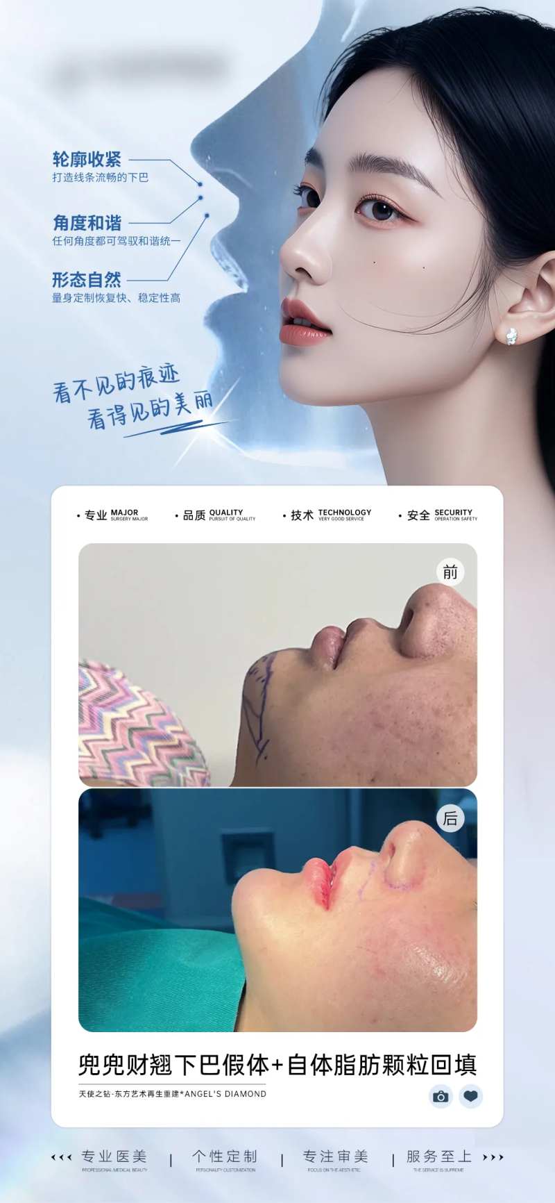 医美假体下巴填充案例海报-采灵感-cailinggan.com