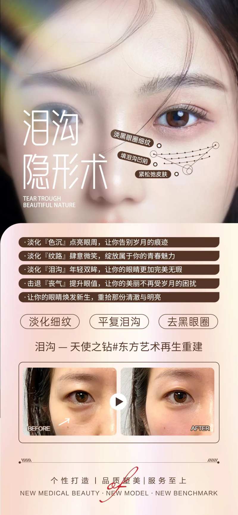 医美泪沟填充案例对比-采灵感-cailinggan.com