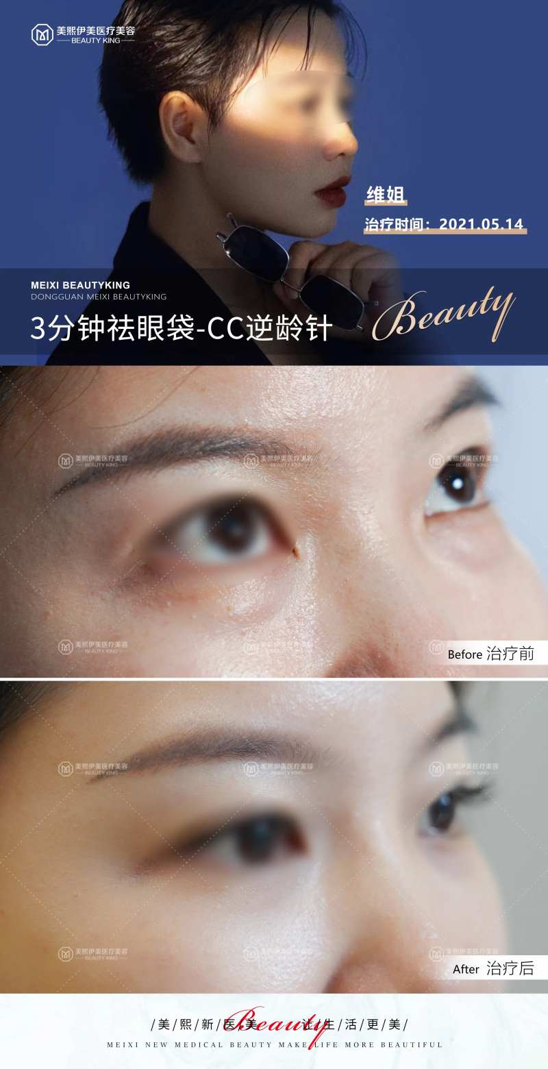 CC逆龄针-采灵感-cailinggan.com